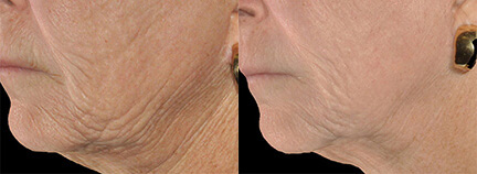 Infini Before and After Photo by Dr. Frank in New York, NY