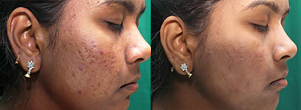 Infini Before and After Photo by Dr. Frank in New York, NY