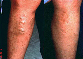 Leg Veins Before and After Photo by Dr. Frank in New York, NY