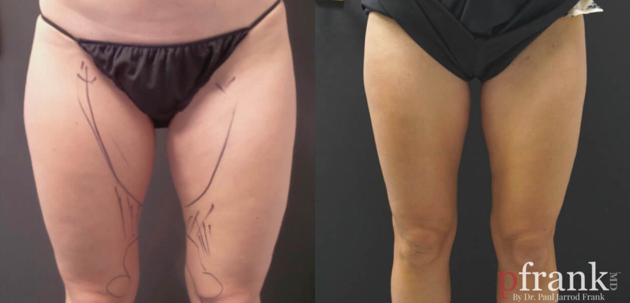 Liposuction Before and After Photo by Dr. Frank in New York, NY