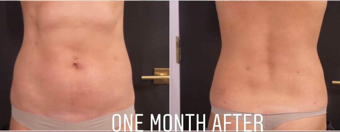 Liposuction Before and After Photo by Dr. Frank in New York, NY