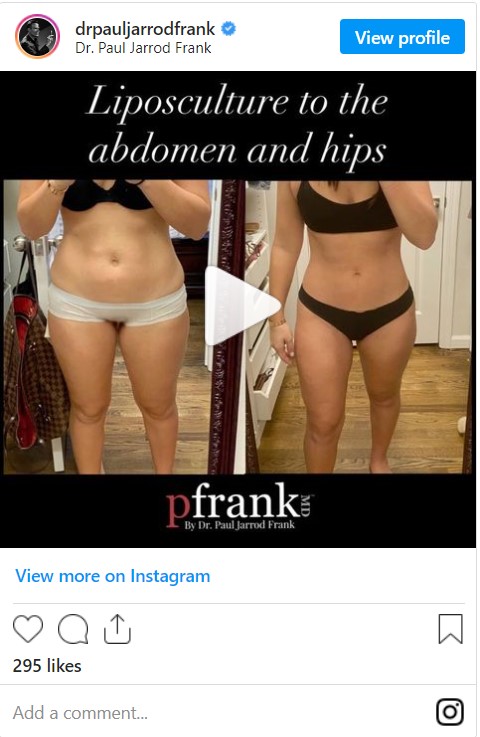 LipoSculpture to the abdomen and hips Before and After photo by Dr. Paul Jarrod Frank of PFRANKMD in New York City, NY