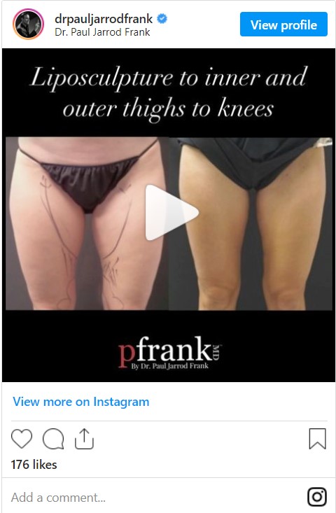 LipoSculpture to inner and outer thighs to knees Before and After photo by Dr. Paul Jarrod Frank of PFRANKMD in New York City, NY
