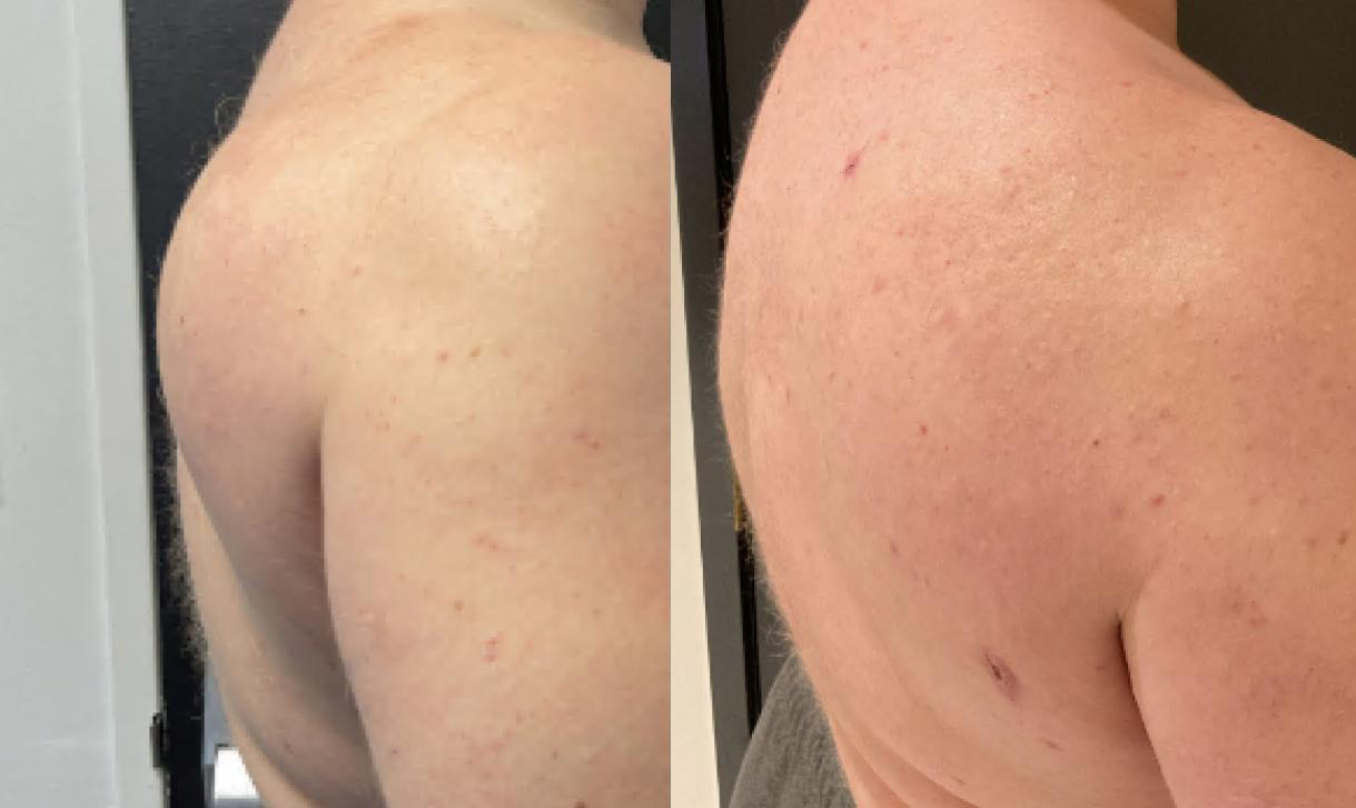 Lipomas Before and After Photo by Dr. Frank in New York, NY