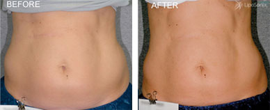 LipoSonix Before and After photo by Dr. Paul Jarrod Frank of PFRANKMD in New York City, NY