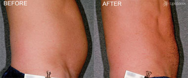 Liposonix Before and After Photo by Dr. Frank in New York, NY