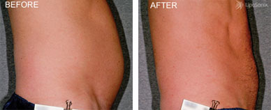 LipoSonix Before and After photo by Dr. Paul Jarrod Frank of PFRANKMD in New York City, NY