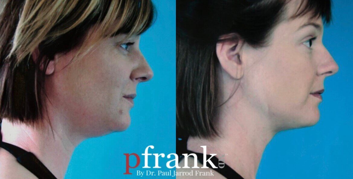 UltraTight™ Before and After photo by Dr. Paul Jarrod Frank of PFRANKMD in New York City, NY