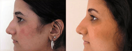 Non-Surgical Nose Job Before and After Photo by Dr. Frank in New York, NY