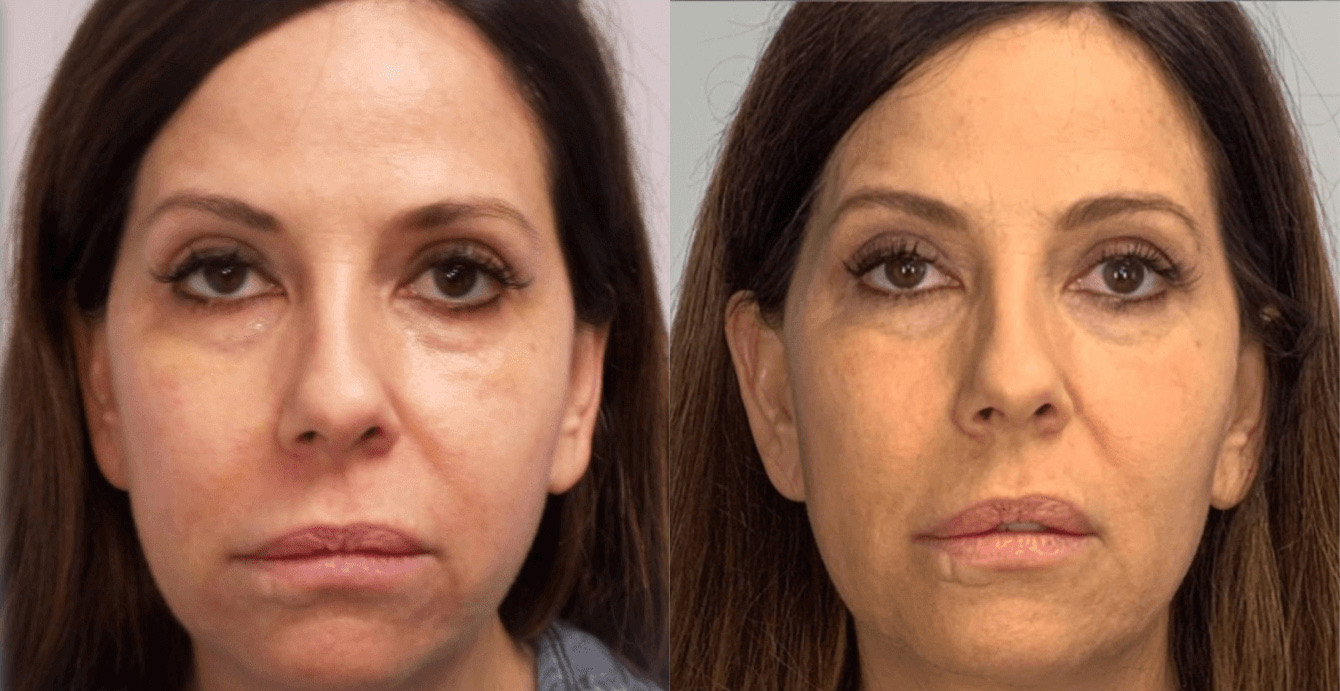 NovaThreads Non-Surgical Thread Lift Before and After Photo by Dr. Frank in New York, NY