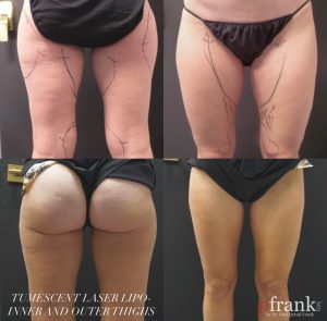 Tumescent Laser Lipo to inner and outer thighs Before and After photo by Dr. Paul Jarrod Frank of PFRANKMD in New York City, NY