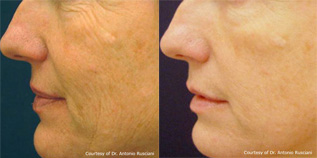 Pelleve Before and After Photo by Dr. Frank in New York, NY