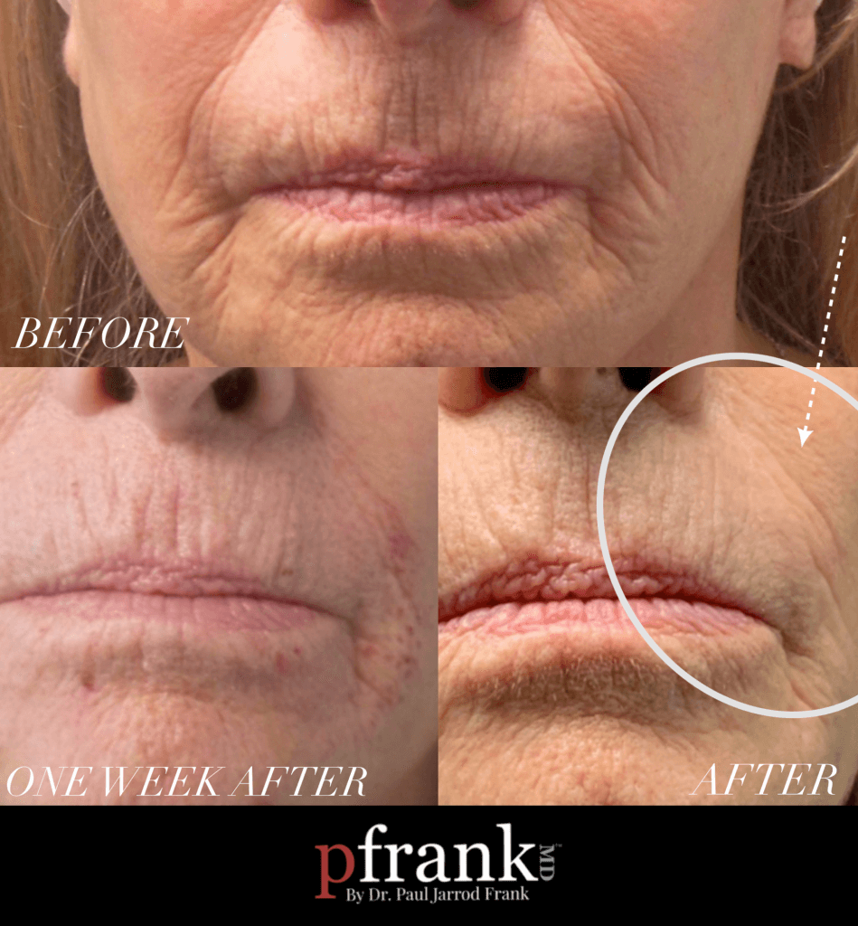 Plasma Resurfacing Before and After photo by Dr. Paul Jarrod Frank of PFRANKMD in New York City, NY