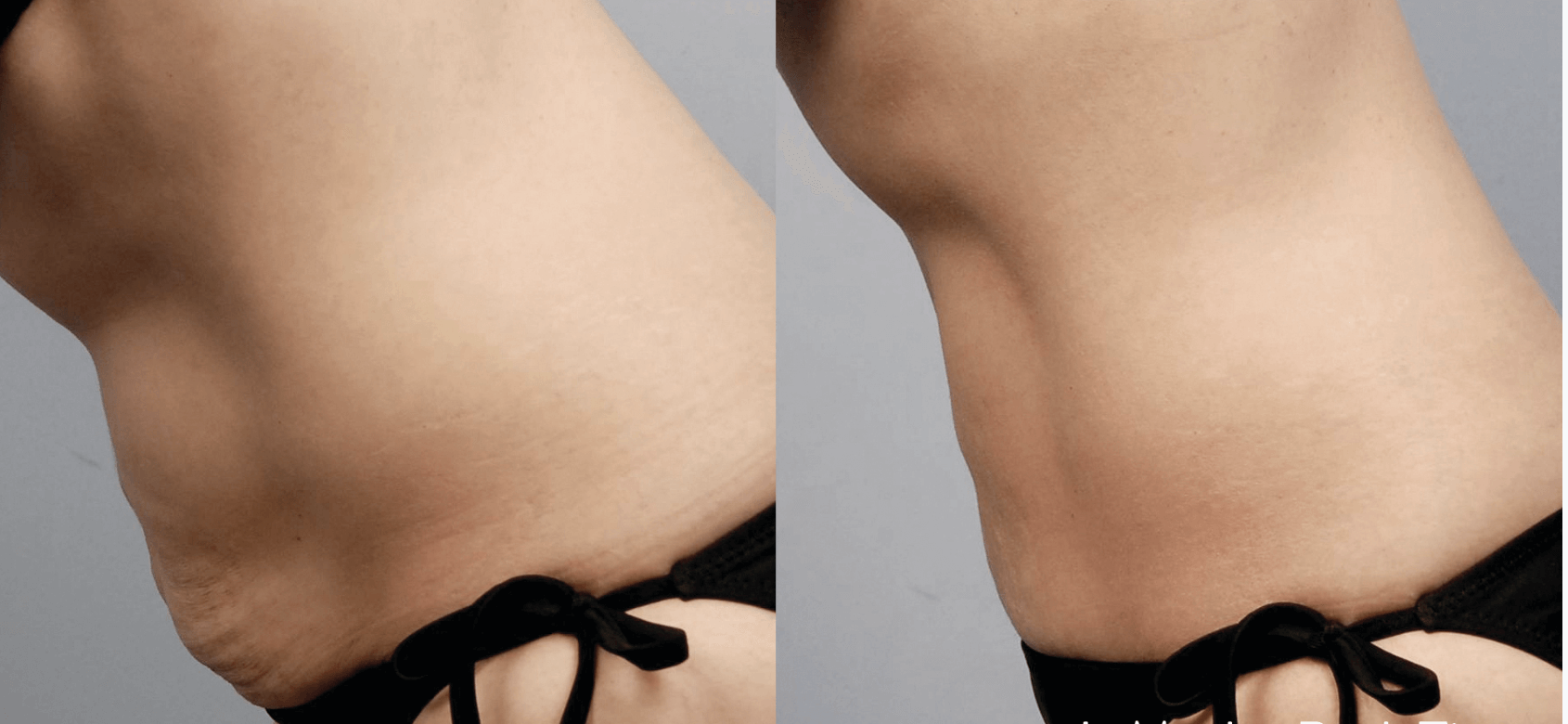 BodyTite Before and After photo by Dr. Paul Jarrod Frank of PFRANKMD in New York City, NY
