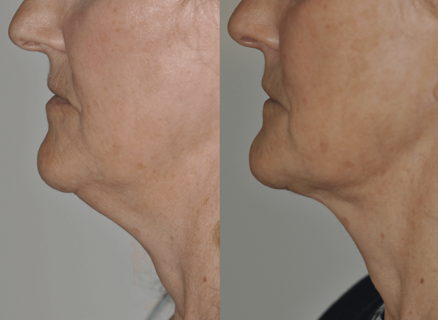 FaceTite Before and After photo by Dr. Paul Jarrod Frank of PFRANKMD in New York City, NY