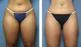 Tumescent Laser Liposuction Before and After photo by Dr. Paul Jarrod Frank of PFRANKMD in New York City, NY