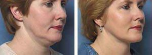 Tumescent Laser Lipo Before and After photo by Dr. Paul Jarrod Frank of PFRANKMD in New York City, NY