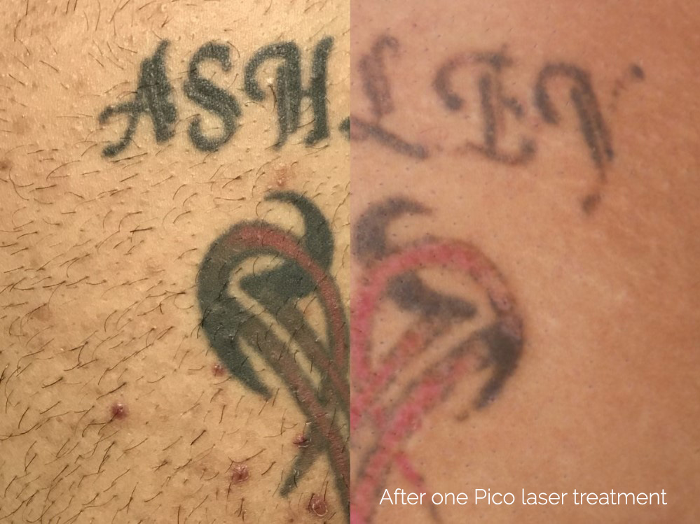 Tattoo Removal With Enlighten III Picosecond Laser Before and After Photo by Dr. Frank in New York, NY