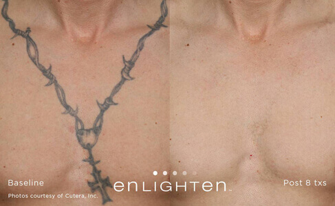 Pigment Protocol Before and After Photo by Dr. Frank in New York, NY