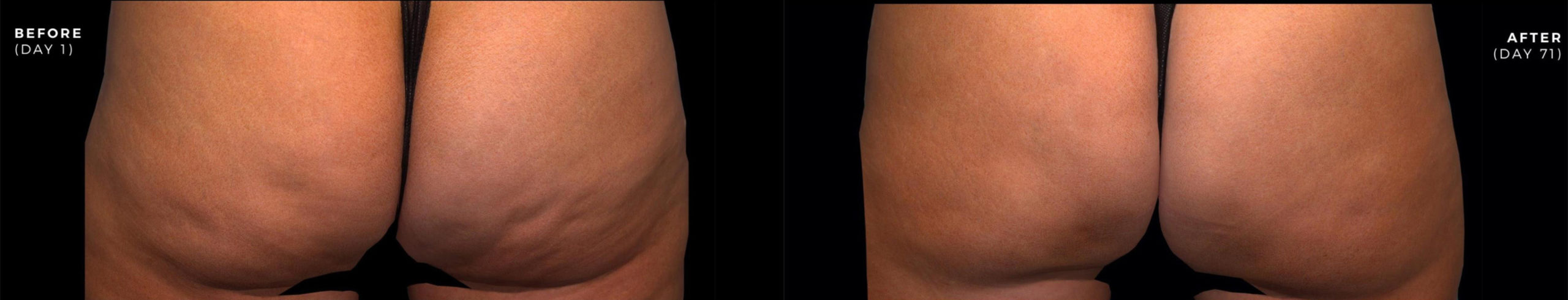 QWO (Cellulite Injectable) Before and After Photo by Dr. Frank in New York, NY