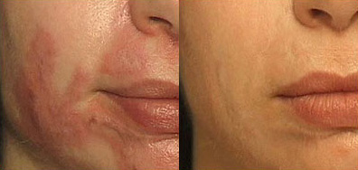 Scar Revision Before and After Photo by Dr. Frank in New York, NY