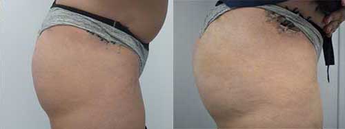 5th Avenue Butt Lift Before and After Photo by Dr. Frank in New York, NY