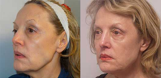 Stem Cell Facelift Before and After Photo by Dr. Frank in New York, NY