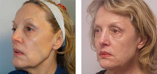 Stem Cell Facelift Before and After photo by Dr. Paul Jarrod Frank of PFRANKMD in New York City, NY