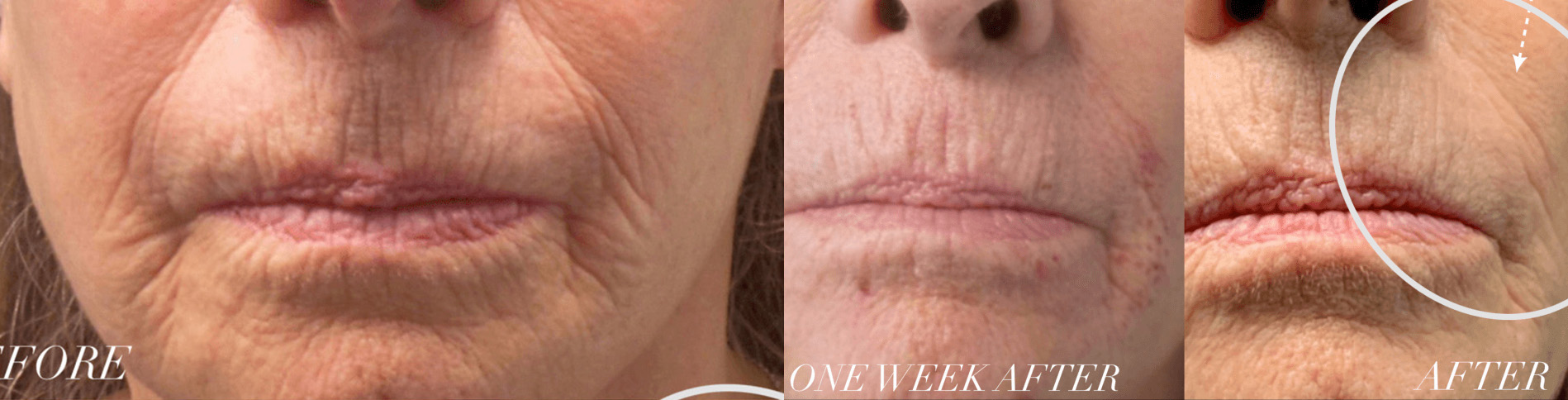 Plasma Resurfacing with the Subnovii Pen Before and After Photo by Dr. Frank in New York, NY