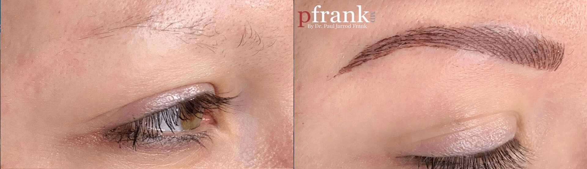 Tattooing for Scars, Stretch Marks, Scalp, and Permanent Makeup Before and After Photo by Dr. Frank in New York, NY