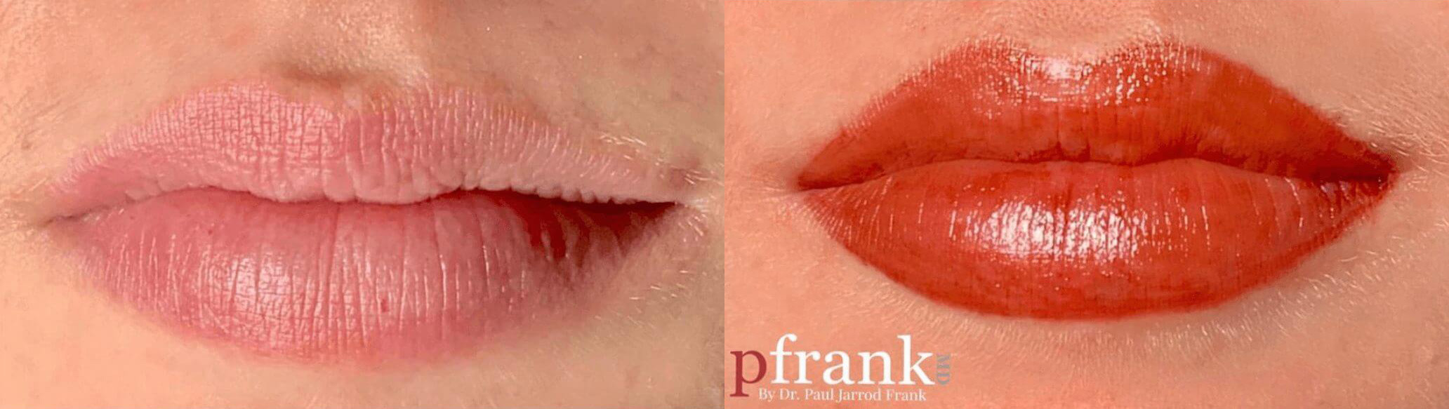 Tattooing for Scars, Stretch Marks, Scalp, and Permanent Makeup Before and After Photo by Dr. Frank in New York, NY