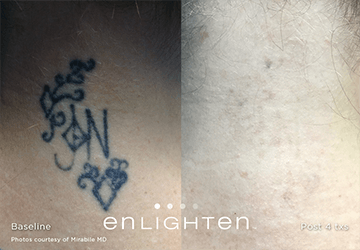 Tattoo Removal With Enlighten III Picosecond Laser Before and After Photo by Dr. Frank in New York, NY