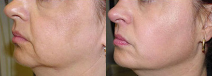Thermage Before and After Photo by Dr. Frank in New York, NY