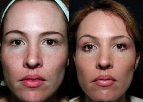 Thermage Before and After Photo by Dr. Frank in New York, NY