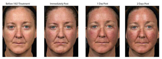 Fraxel Thulium Before and After Photo by Dr. Frank in New York, NY