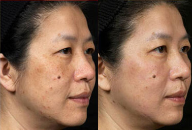 Fraxel Thulium Before and After Photo by Dr. Frank in New York, NY