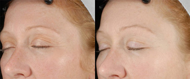 TLT (Tighten, Lift, and Tone) Treatment Before and After Photo by Dr. Frank in New York, NY