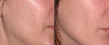 TLT (Tighten, Lift, and Tone) Treatment Before and After Photo by Dr. Frank in New York, NY