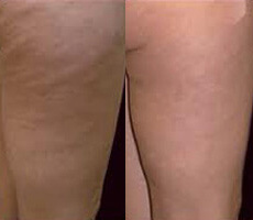 VASERsmooth Before and After Photo by Dr. Frank in New York, NY