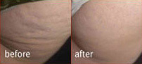 VelaSmooth™ Before and After Photo by Dr. Frank in New York, NY