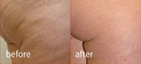 VelaSmooth™ Before and After Photo by Dr. Frank in New York, NY