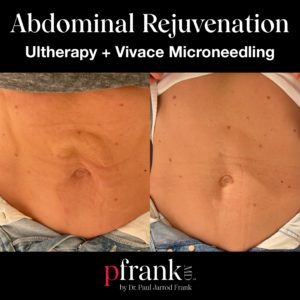 Abdominal Rejuvenation before and after photo by Dr. Paul Jarrod Frank of PFRANKMD in New York City, NY