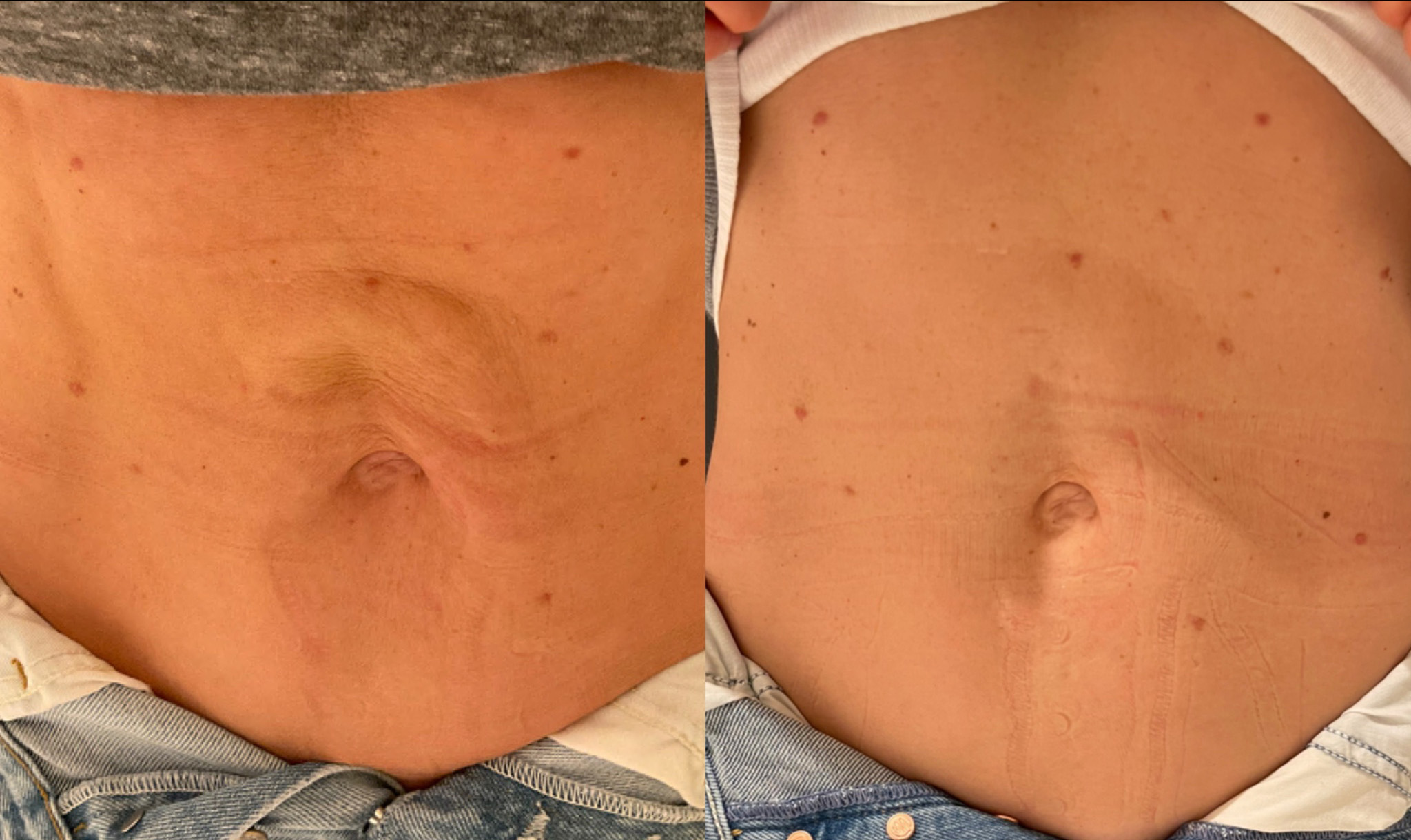 Ultherapy + Vivace Microneedling Before and After Photo by Dr. Frank in New York, NY
