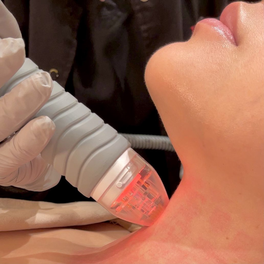 Microneedling the neck of a PFrankMD patient