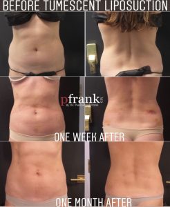 Tumescent Laser Liposuction Before and After photo by Dr. Paul Jarrod Frank of PFRANKMD in New York City, NY