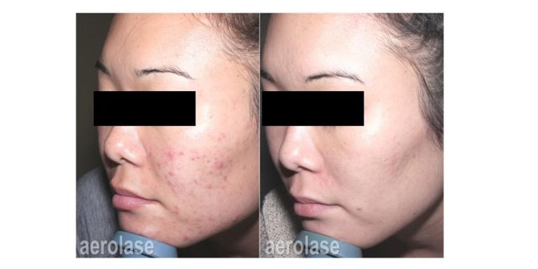 Acne Scarring Before and After photo courtesy of aerolase