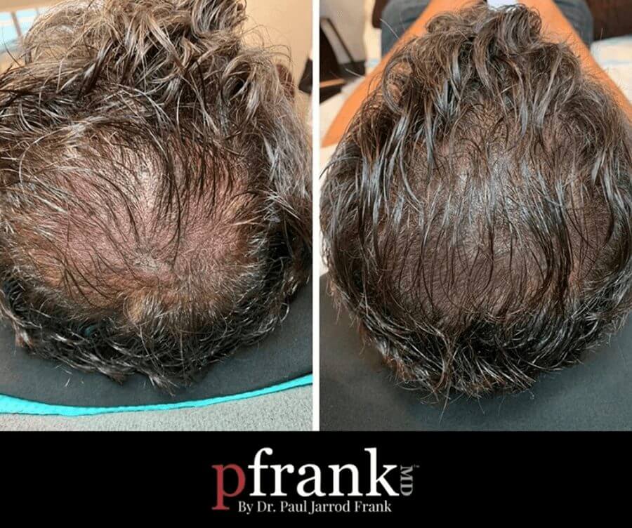 Scalp Micropigmentation Before and After photo by Dr. Paul Jarrod Frank of PFRANKMD in New York City, NY