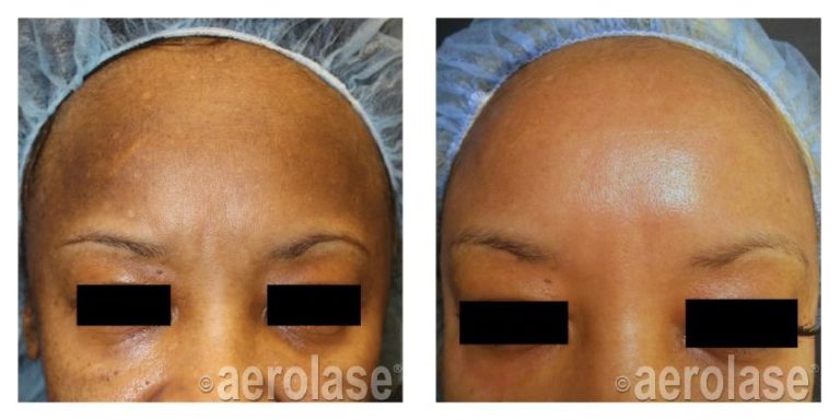Acne Scarring Before and After photo courtesy of aerolase