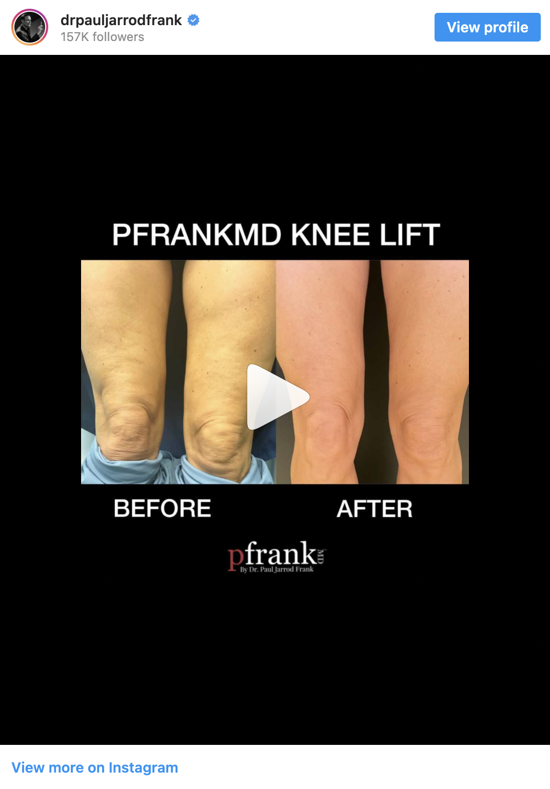 Knee Lift Before and After video by Dr. Paul Jarrod Frank of PFRANKMD in New York City, NY