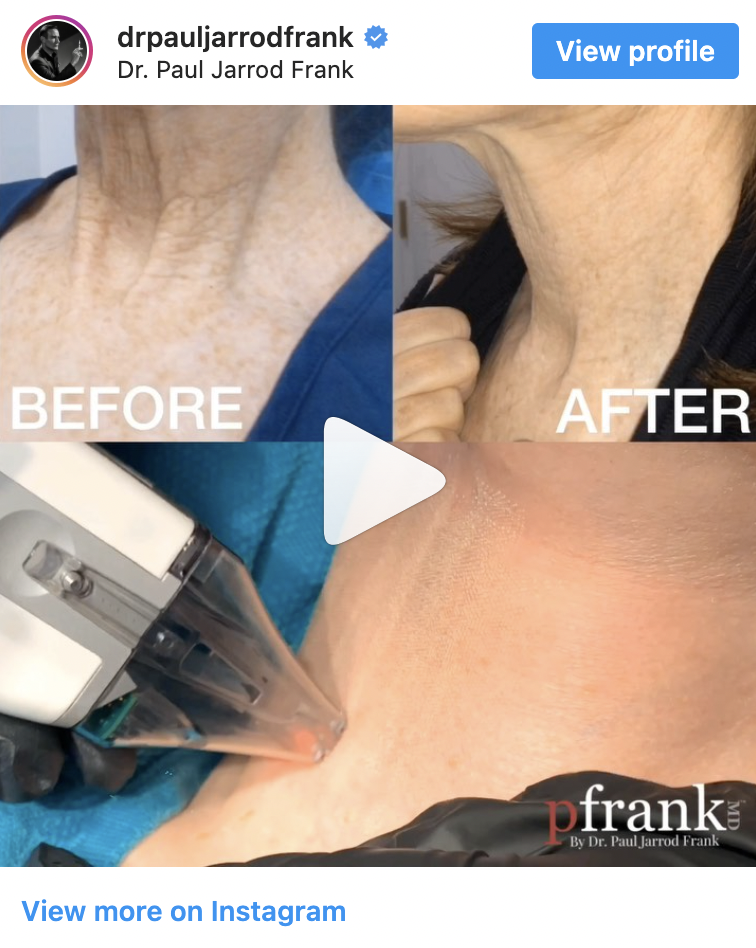Fraxel Restore treatment video by Dr. Paul Jarrod Frank of PFRANKMD in New York City, NY